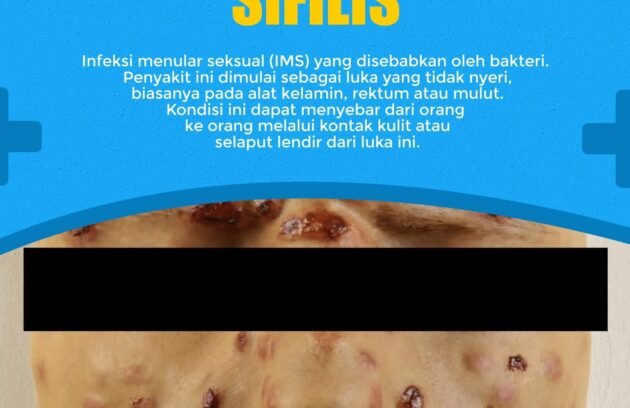 Sifilis Klinik Penyakit Menular Seksual